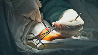 Varicose Vein Surgery Vein Stripping [upl. by Doehne]