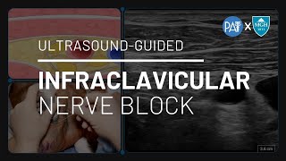 Ultrasound Guided Infraclavicular Brachial Plexus Block NRAP Academys AnesthesiaExamcom [upl. by Viridissa]