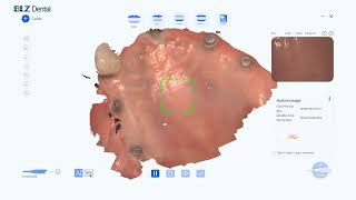 🌟BLZ Dental Intraoral Scanner Real Case StudyEdentulous Patient Case📋 [upl. by Annovahs581]