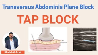 محاضرة TAP block  خالد العايد [upl. by Dowell]