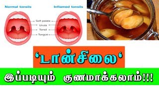 டான்சில்க்கு எளிய வீட்டு வைத்தியம் Tonsils and Adenoids treatment [upl. by Eidnil]