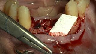 Suturing technique for the fixation of the Collagen MembraneDrCho SeungHwan [upl. by Darach191]