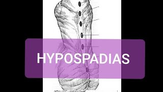 Hypospadias [upl. by Lomasi]