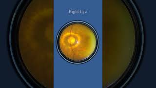 Smartphone Fundus Videography  Fundus Photography [upl. by Ettennej406]