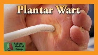 Plantar Wart Treatment  Auburn Medical Group [upl. by Kcerred]