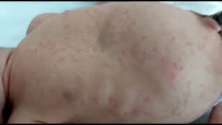 pectus excavatumsub sternal retraction Erythema toxicum neonatorum [upl. by Kirad]