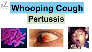 Whooping Cough Pertussis  Transmission Pathophysiology Symptoms Diagnosis Treatment [upl. by Kyl381]