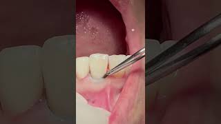 Retraction cord dentist dental teeth viral [upl. by Laural434]