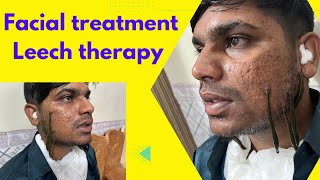 Does leech therapy work for pimples  मुंहासे को ठीक करेगा जोंक • pimplesacnecystleechshorts [upl. by Navlys714]