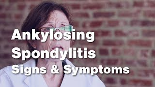 Ankylosing Spondylitis  Signs and Symptoms 2 of 5 [upl. by Inacana]