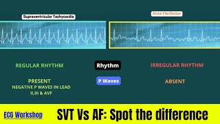 ECG Workshop SVT amp AF on simulation [upl. by Meadows]