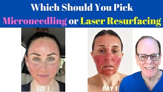 Should You Get Microneedling or Laser Resurfacing  Plastic Surgeons Advice [upl. by Busch]