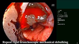 Tracheal Melanoma  Central Airway Obstruction Rigid bronchoscopic debulking [upl. by Mesics]