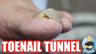 DAMAGED THICK TOENAIL HAS NOW GROWN INTO A TOENAIL TUNNEL [upl. by Nivram]