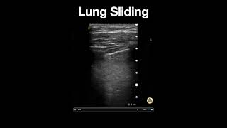 Normal Lung Sliding [upl. by Leschen32]