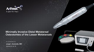 Minimally Invasive Distal Metatarsal Osteotomies of the Lesser Metatarsals [upl. by Odraude]