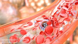 Metastasis and angiogenesis [upl. by Llenrub]