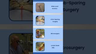 Liposarcoma Screening amp Treatment Options [upl. by Adrian]