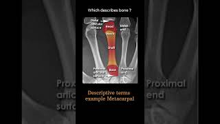 Descriptive terms example  Metacarpal Musculoskeletal Xray Quiz anatomy radiologychannel007 [upl. by Daegal]