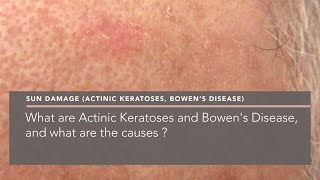 What are Actinic Keratoses and Bowens Disease and what are the causes [upl. by Leon100]