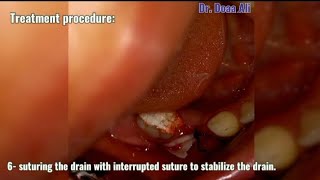 What is the role of drain in treatment of odontogenic infection [upl. by Atiekahs]