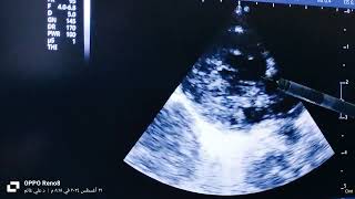 Fallot tetralogy ē Rt sided aortic arch [upl. by Wettam]