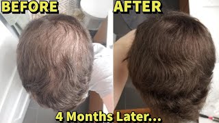 He Was Microneedling WITHOUT FinasterideMinoxidil For 4 MonthsSHOCKING Results [upl. by Navap]