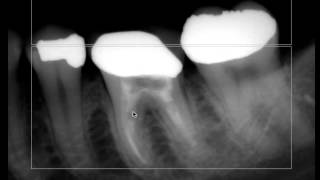 Endodontic Radiographs  Is there a minimum number [upl. by Seiuqram]