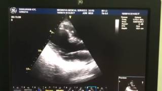 Echocardiography of anterior wall infarction [upl. by Leba886]