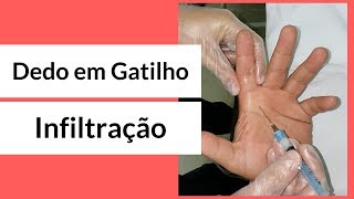 Dedo em Gatilho  Tratamento com Infiltração [upl. by Quin]