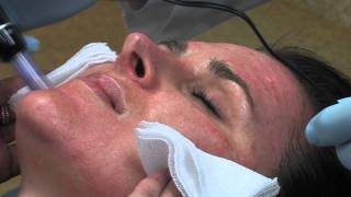 Dr Mark B Taylor Review of Dermapen Micro Needling  Gateway Aesthetics [upl. by Yenial874]