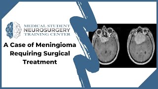 A Case of Meningioma Requiring Surgical Treatment [upl. by Ryder]