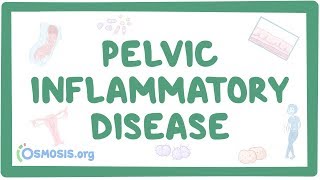 Pelvic inflammatory disease  causes symptoms diagnosis treatment pathology [upl. by Lilly]