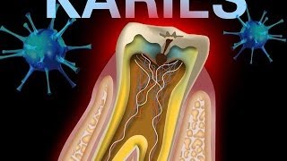 nicht immer muss bei Karies gebohrt werden  Initialkaries [upl. by Lash]