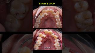 Cost  2500 for this case Braces crooked teeth braces orthodontist dentist [upl. by Leummas]