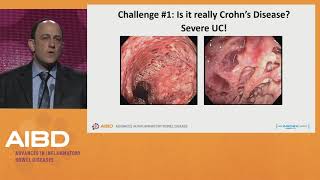 Challenges in the treatment of severe Crohns disease [upl. by Tufts101]