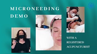 Microneedling Demo With A Registered Acupuncturist [upl. by Ocsisnarf]