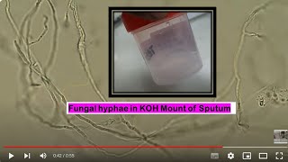 Fungal branched hyphae in KOH mount of Sputum Microscopy [upl. by Ley561]