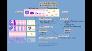 Anemia differential diagnosis [upl. by Radu]