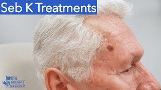 Seborrheic Keratosis Treatment amp Removal Liquid Nitrogen amp Curetagge [upl. by Asante]