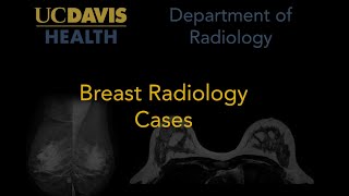 Breast calcification patterns vascular calcification [upl. by Hazeefah]