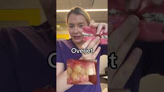 Overjet vs overbite braces overbite overjet [upl. by Aydni286]