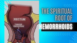 The SPIRITUAL ROOT of Hemorrhoids [upl. by Rab780]