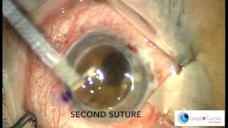 Perforating Keratoplasty PKP by Dr Alex Lange [upl. by Licha]