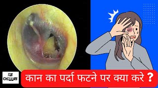 Part1 कान का पर्दा फटने पर क्या करे Ruptured ear drum I Traumatic eardrum perforation I [upl. by Malinda554]