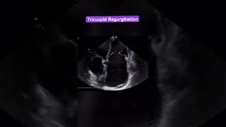 Tricuspid Regurgitation 2d Echo  colour Doppler cardiology echocardiography heart [upl. by Ocsicnarf]