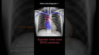 Superior vena cava SVC anatomy 187 chest Xray tubes Quiz radiologychannel007 [upl. by Htennek775]