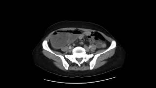 Colon adenocarcinoma [upl. by Bernat]