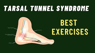 Tarsal Tunnel Syndrome 6 Best Exercises [upl. by Aneerhs515]