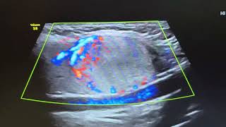 Ultrasound of hyperplastic adenomatous nodule in right lobe of thyroid [upl. by Analaf]